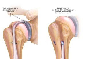 Arthroscopic Rotator Cuff Repair and Bicep Tenodesis: Right