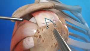 SHOULDER REPLACEMENT SURGERY TO FIX A ROTATOR CUFF TEAR - IS IT