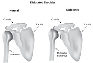 Is This Serious? Why Do My Shoulders Click, Crack Or Pop? - pt Health