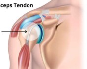illustration of bicep tendon
