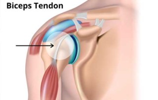 illustration of bicep tendon