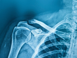 Fractures of the Shoulder & Clavicle