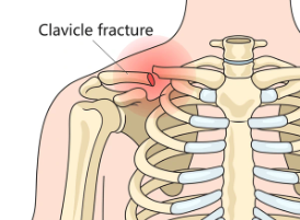 Shoulder Pain Symptoms