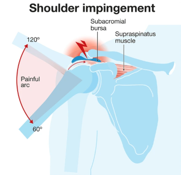 Shoulder Impingement