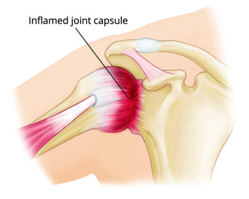 Shoulder Pain Symptoms