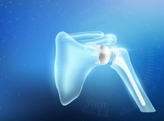 Minimally Invasive Total Shoulder Replacement Surgery Diagram - Cleveland Shoulder Institute