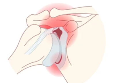 Arthroscopic Labral Repair / Shoulder Stabilization