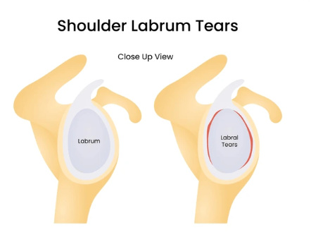 Shoulder Pain Symptoms