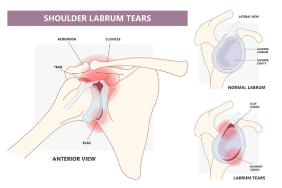 Labral Tears