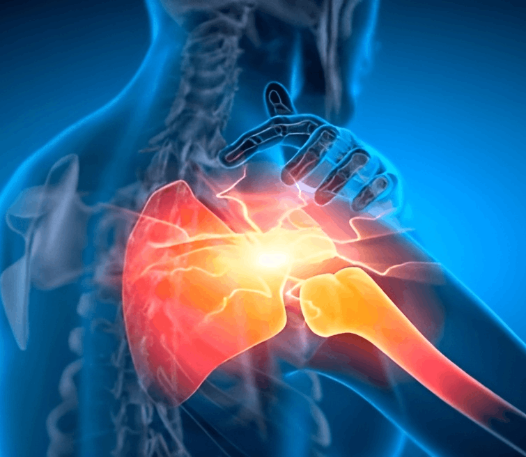 Avascular Necrosis of the Shoulder