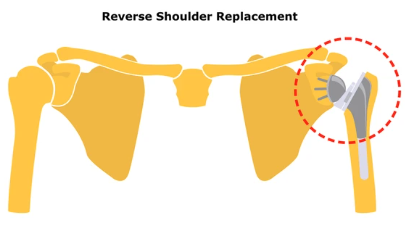 Shoulder Pain Symptoms