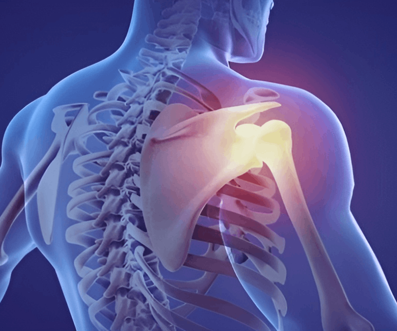 Post-Traumatic Shoulder Arthritis