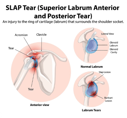 SLAP Tear Repair