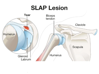 Shoulder Pain Symptoms